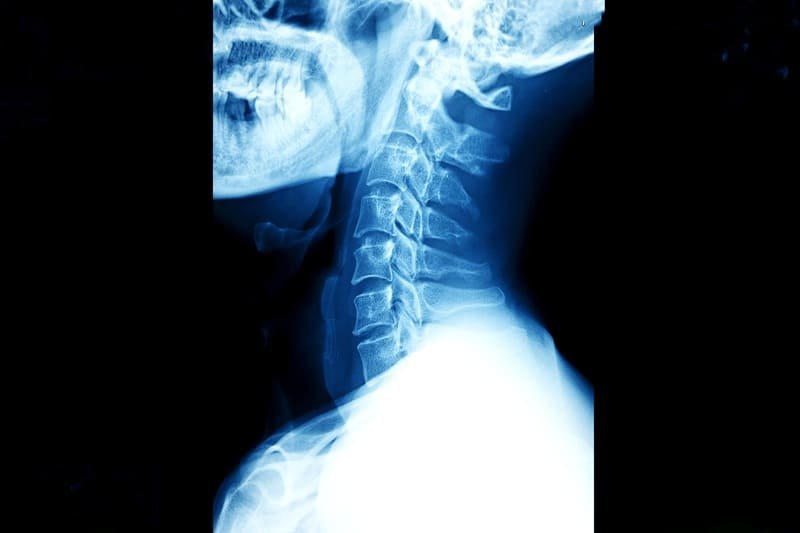 Radiografía de columna cervical