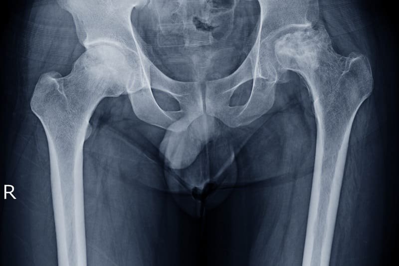 Radiografía de fémur en Guadalajara, Jalisco