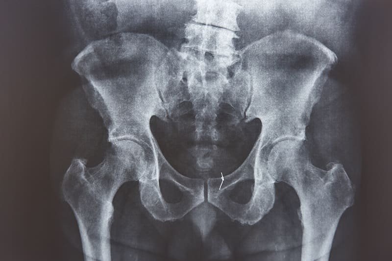 Radiografía de pelvis en Guadalajara, Jalisco